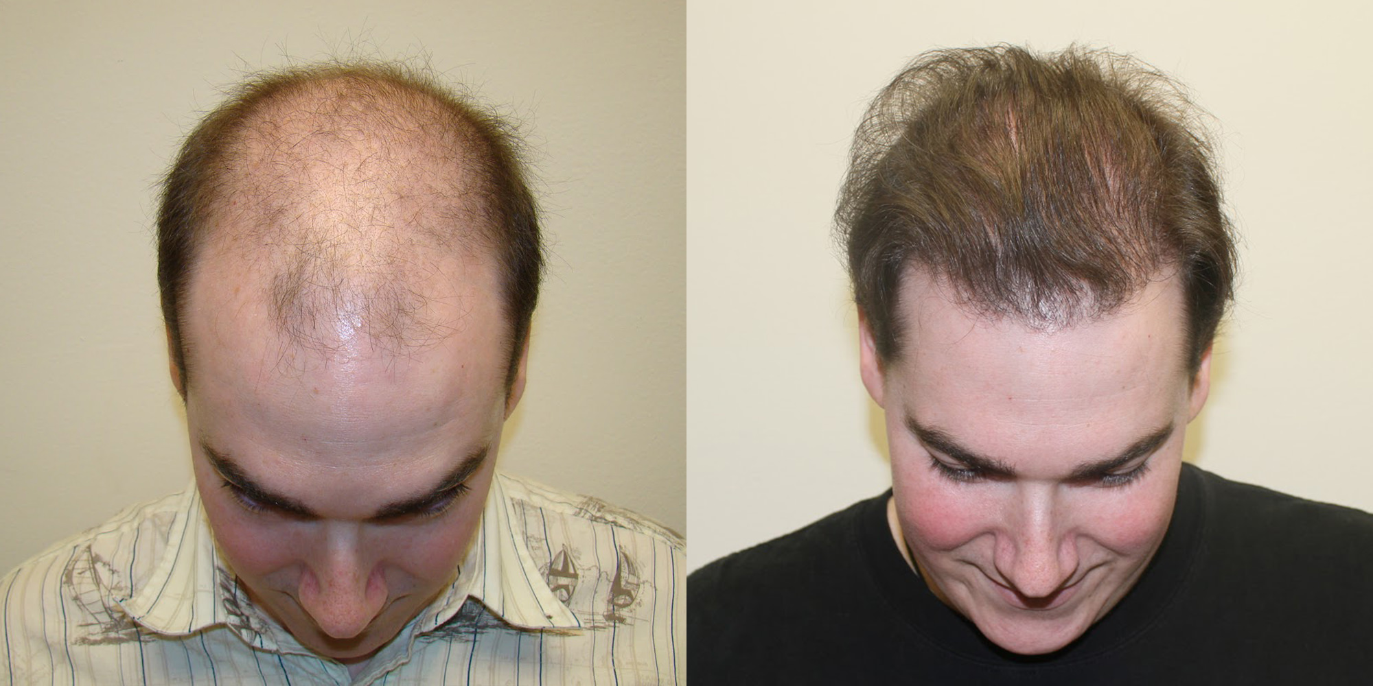 A hair transplant procedure has become extremely popular recently for good ...