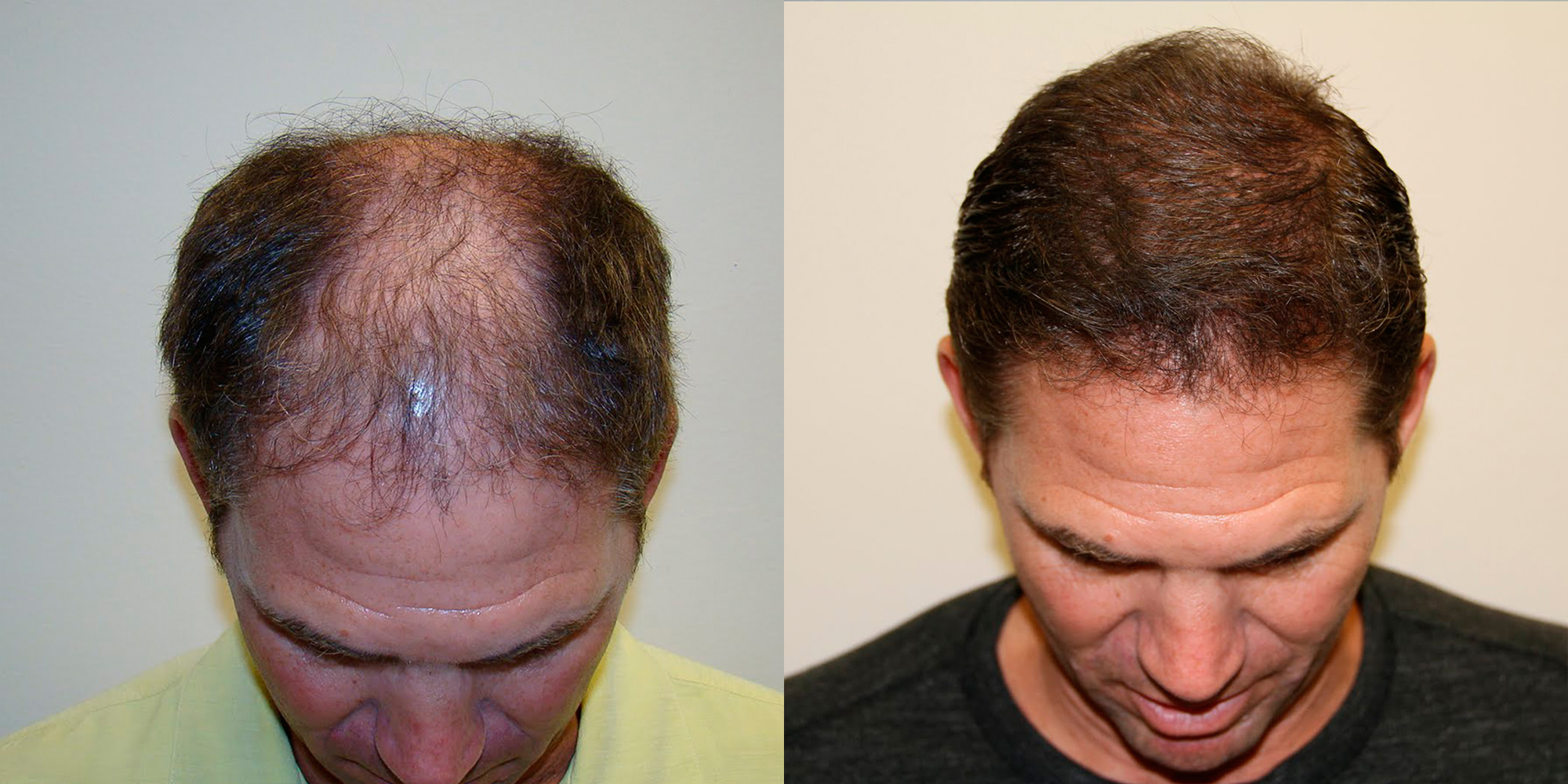 7 Month MaxHarvest™ Results - Complete Hair Loss ...